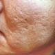 Рубці і шрами на обличчі від прищів: як їх можна прибрати?
