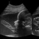 Protocol Screening Ultrasound Studies 32 weeks