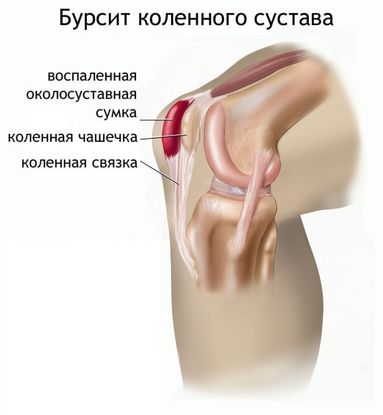 akutna kratkotrajna bol u zglobu koljena