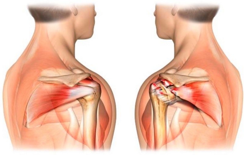 Bol u zglobu ramena - što učiniti, kako liječiti? - Miozitis - 