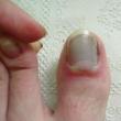 Manifestations and recovery in case of marginal fracture of the first toe