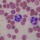 白血球増加症：いつ、なぜ発生するか、白血球の形態、分類および機能