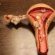 Serviks ve endometriyumun hiperplazisi: neden tedavi gerekli?