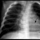 Fracture of the ribs - the danger in each conceals